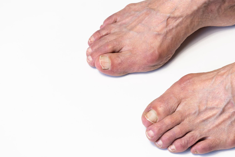 Why Choose Our Bunion Treatments?
