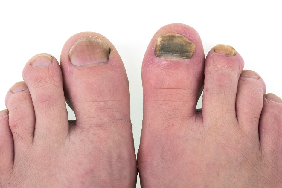 Why Choose Our Diabetic Foot Treatments?