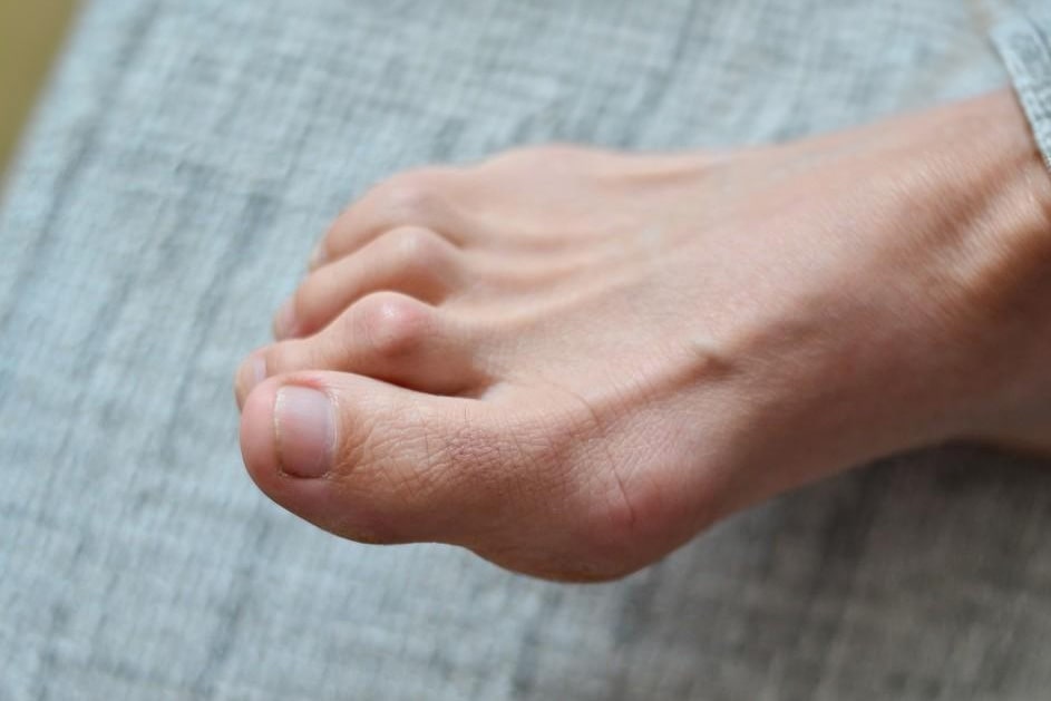 Why Choose Our Hammertoe Treatments?