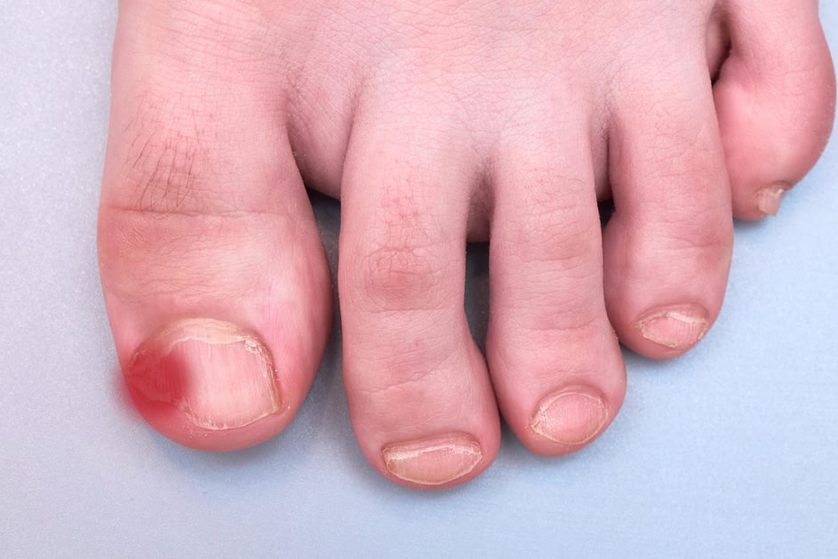 Why Choose Our Ingrown Toenail Treatments?