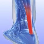 Achilles Tendinitis vs Tendonitis What Are the Differences?