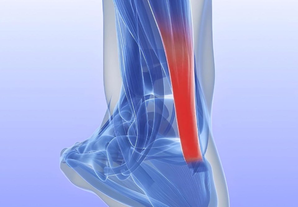 Achilles Tendinitis vs Tendonitis What Are the Differences?