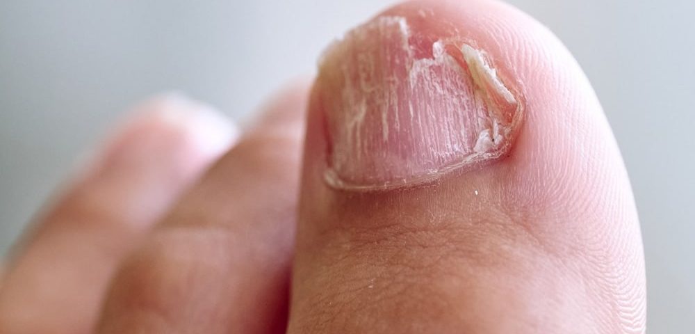 Best Way to Remove Fungus From Toenail