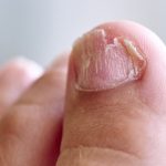 Best Way to Remove Fungus From Toenail