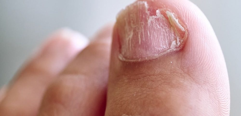 Types of Nail Fungus and Treatment