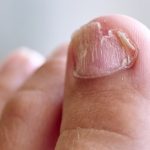 Types of Nail Fungus and Treatment
