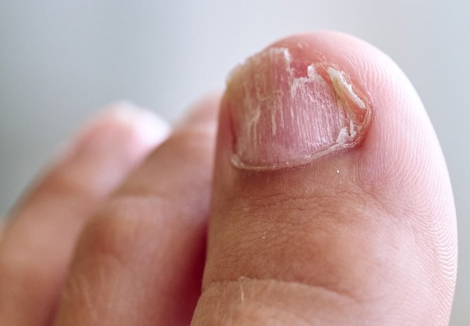 Types of Nail Fungus and Treatment