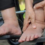 Are Diabetes-Related Foot Problems Genetic or Hereditary?