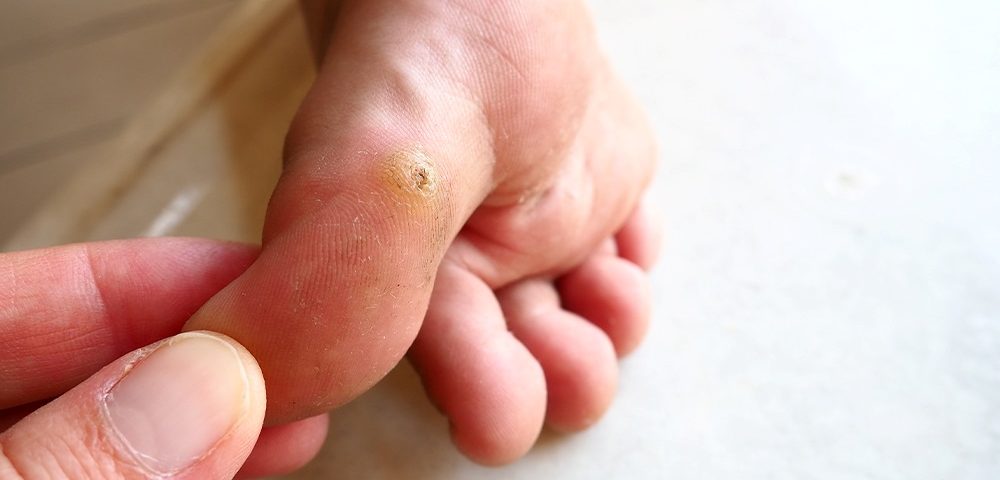 Are Plantar Warts on Feet Contagious?