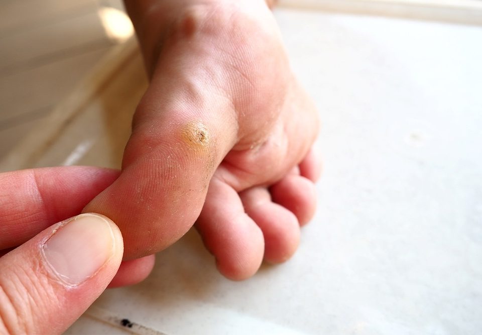 Are Plantar Warts on Feet Contagious?