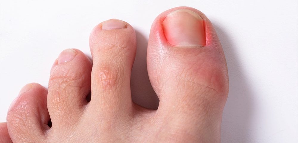 Can an Ingrown Toenail Heal Itself?