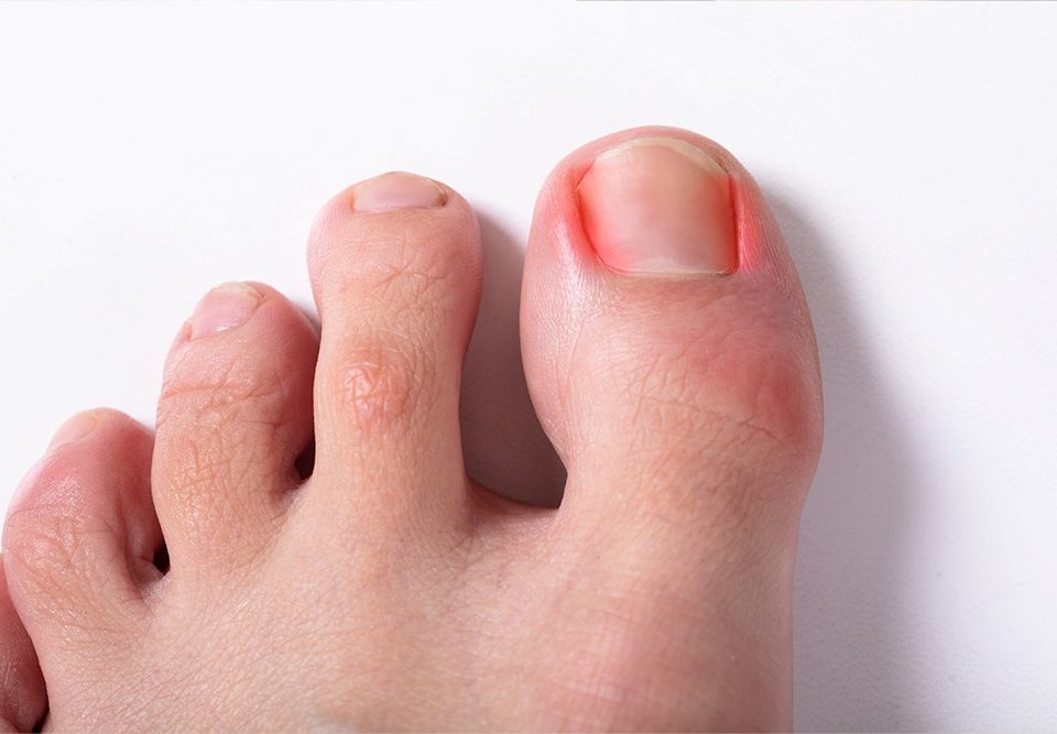 Can an Ingrown Toenail Heal Itself?