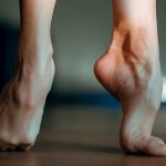 Is Hammertoe Hereditary?