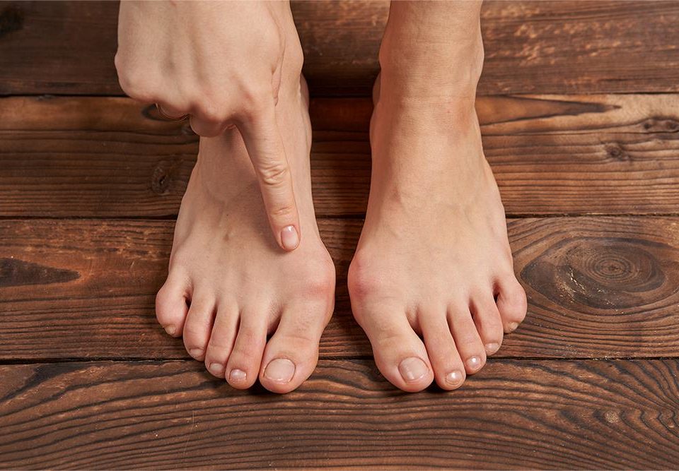 What is the Difference between a Bunion and Hallux Valgus?