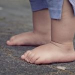 Pediatric Flatfoot Deformity and Its Treatment