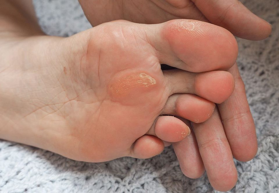 What Are Different Types of Plantar Warts?
