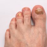 What are Toenail Fungus Thick Nails?