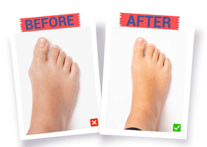 Bunion-Landing-Page
