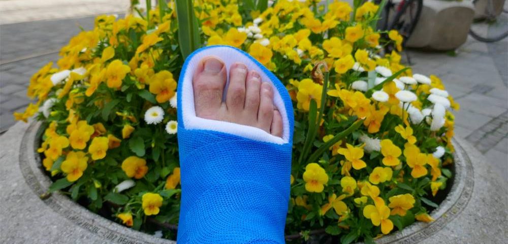 Bunion Surgery Recovery Week by Week