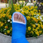 Bunion Surgery Recovery Week by Week