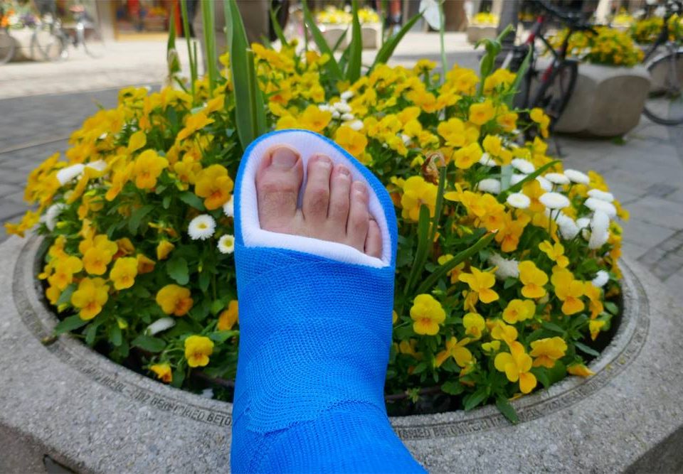 Bunion Surgery Recovery Week by Week