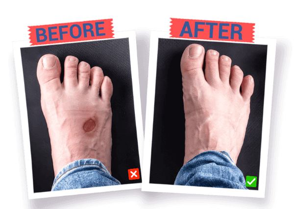 Diabetic Foot Landing