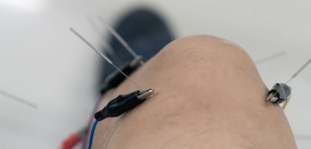 Does Acupuncture Treat Morton's Neuroma?