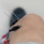 Does Acupuncture Treat Morton's Neuroma?