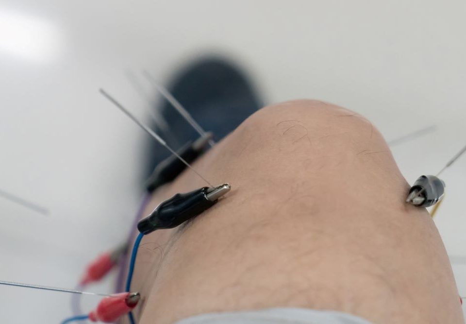 Does Acupuncture Treat Morton's Neuroma?