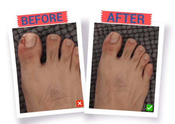 Ingrown Toenail Landing