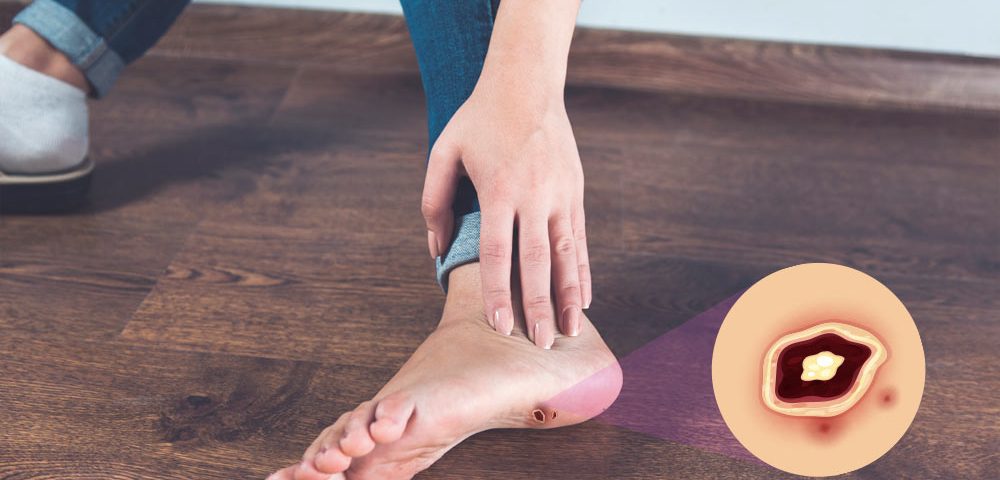 What is the Best Dressing for Diabetic Foot Ulcers?