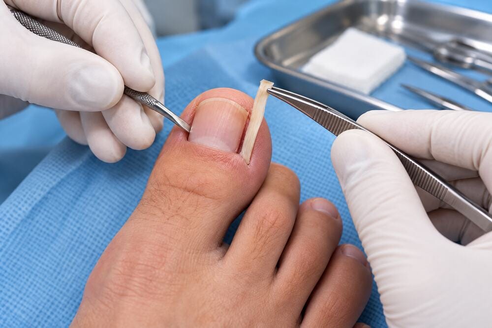 5 Signs of Infection After Toenail Removal Surgery