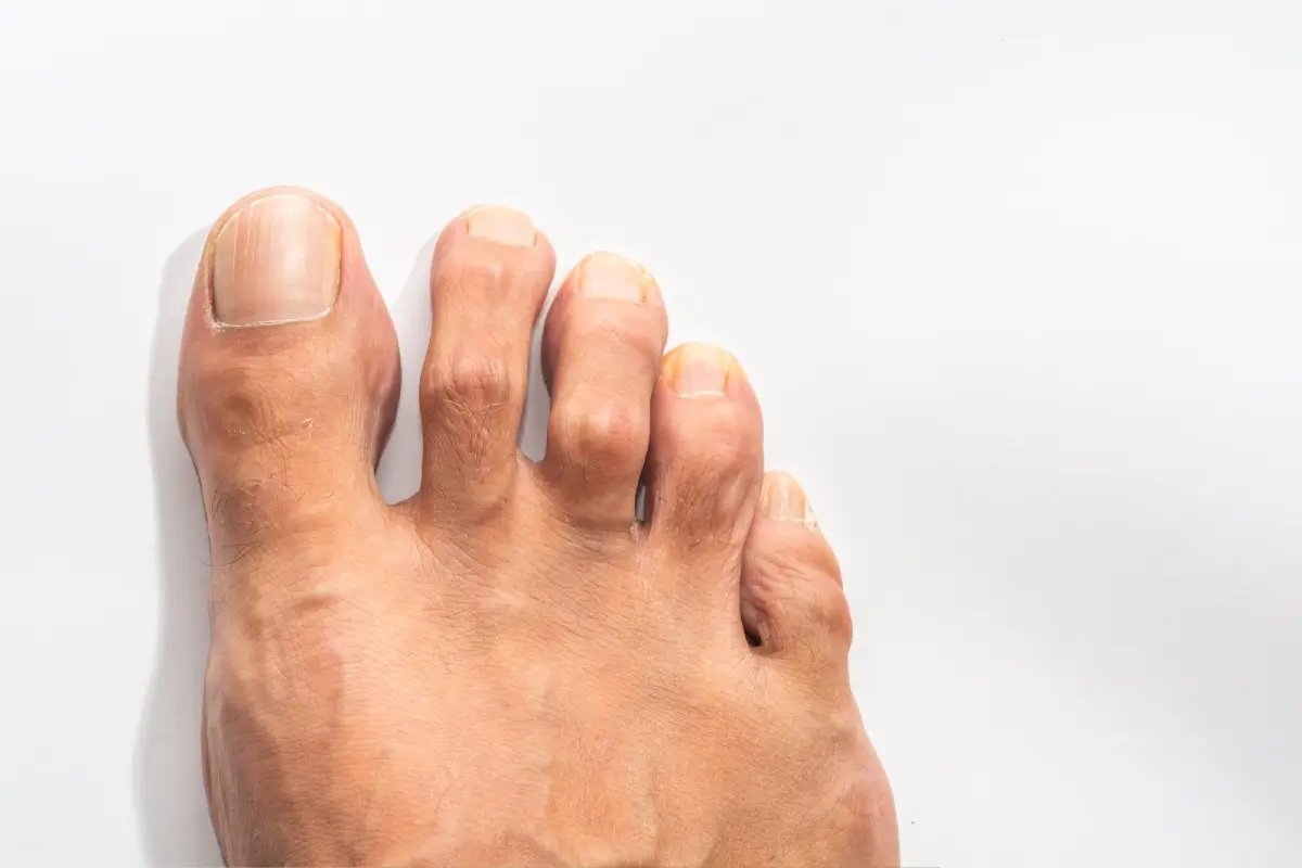 Hammer Toe Treatments in Chandler, AZ