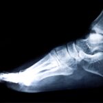 Foot Fusion Surgery Cost in Phoenix, AZ