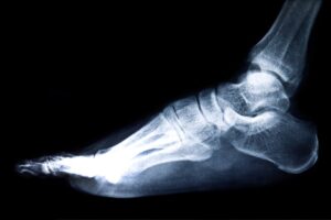 Foot Fusion Surgery Cost in Phoenix, AZ