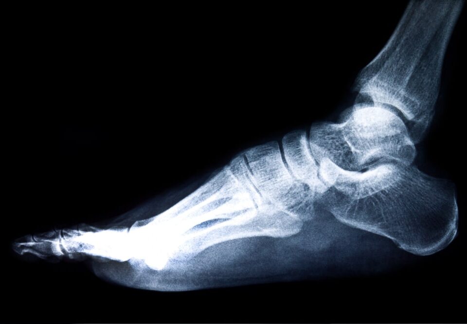 Foot Fusion Surgery Cost in Phoenix, AZ