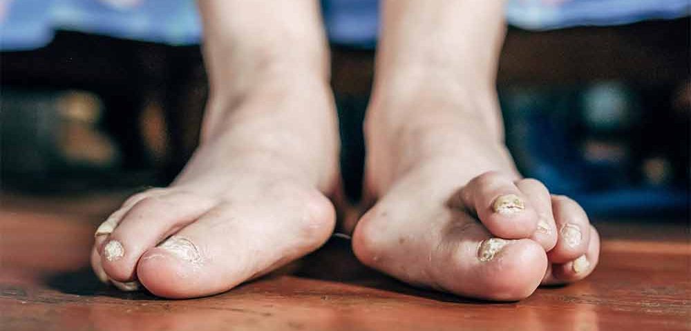 10 Common Foot Problems