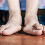 10 Common Foot Problems