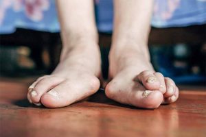10 Common Foot Problems