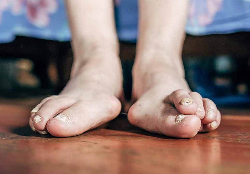 10 Common Foot Problems