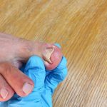 How to Know If It's an Ingrown Toenail in Phoenix