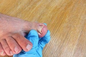 How to Know If It's an Ingrown Toenail in Phoenix