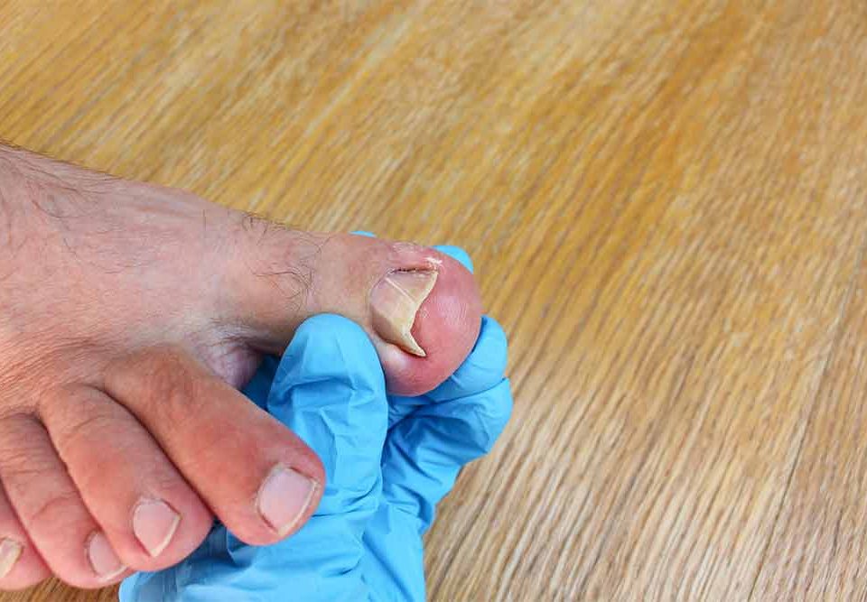 How to Know If It's an Ingrown Toenail in Phoenix