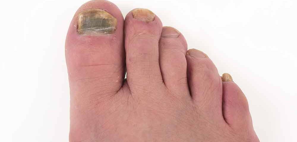 Podiatrists Treat Toenail Fungus