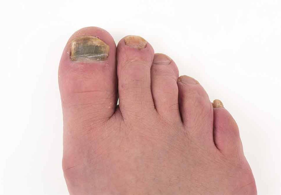 Podiatrists Treat Toenail Fungus