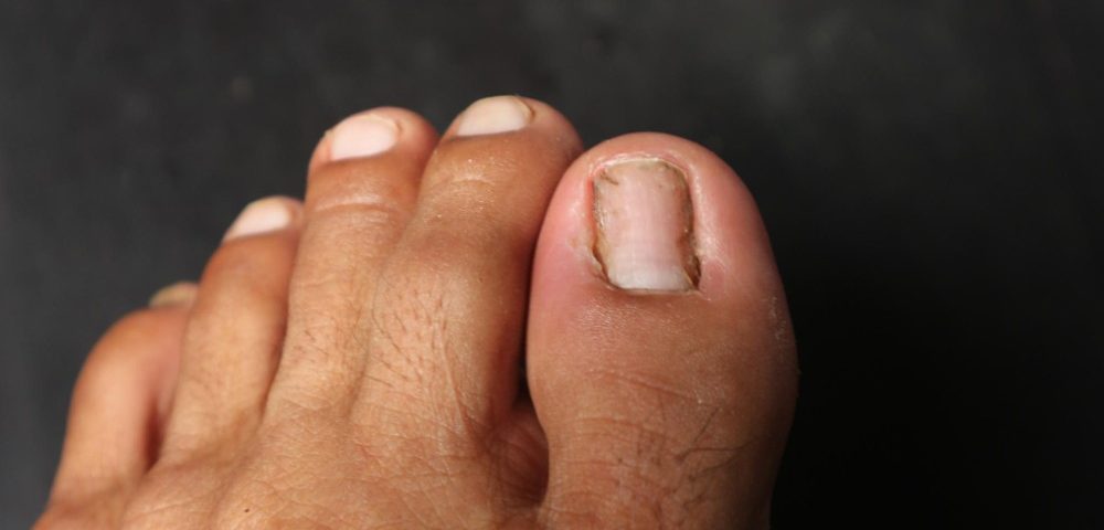 Toenail Fungus vs Nail Damage What are the Differences