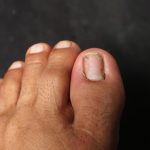 Toenail Fungus vs Nail Damage What are the Differences