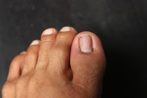 Toenail Fungus vs Nail Damage What are the Differences