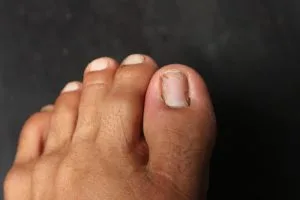 Toenail Fungus vs Nail Damage What are the Differences