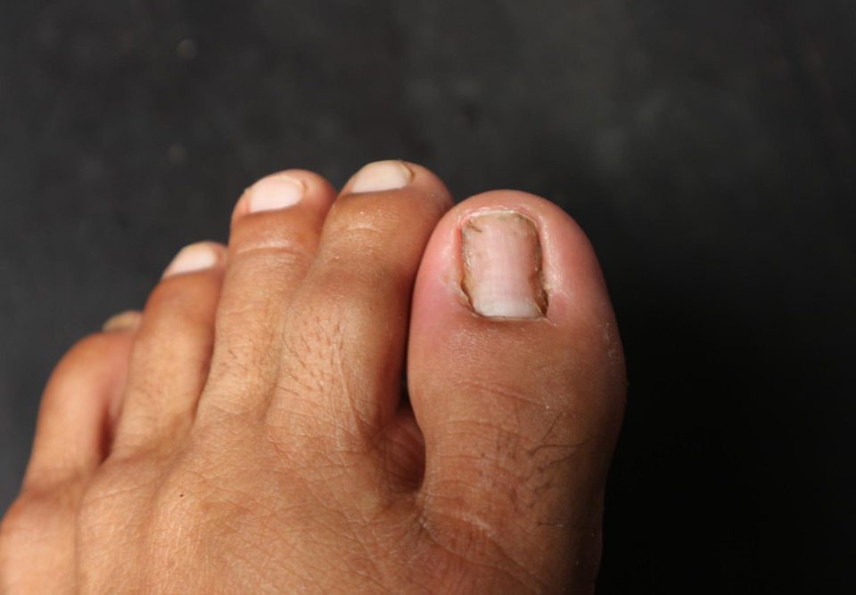 Toenail Fungus vs Nail Damage What are the Differences